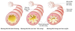 Một số vấn đề về bệnh hen phế quản
