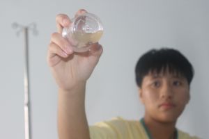 Vật liệu trám răng rơi vào xoang hàm