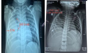 1 giờ phẫu thuật cứu bệnh nhi bị tràn mủ dày dính màng phổi