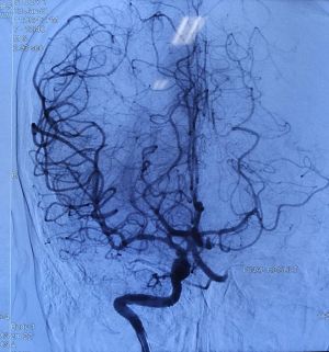 Cứu bệnh nhân khỏi nguy cơ bị liệt