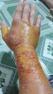 Không nên tự ý đắp thuốc nam lên vết thương