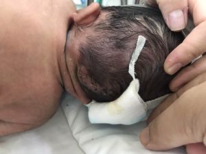 Bóc tách khối thoát vị não chẩm lớn cho bé trai