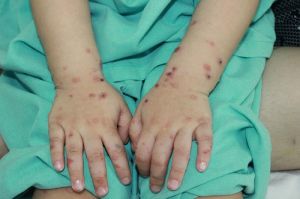 Những dấu hiệu nhận biết của bệnh tay chân miệng