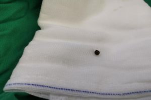 Hiếm gặp: Hạt tiêu nằm trên đỉnh phổi người đàn ông suốt 7 năm