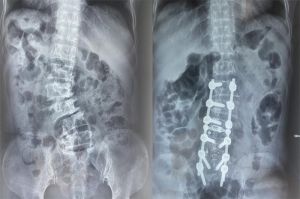 Phẫu thuật chỉnh nắn cột sống cho bệnh nhân vẹo cột sống suốt 12 năm