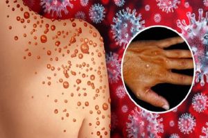 Không chủ quan với bệnh đậu mùa khỉ