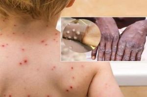 Công văn khẩn phòng, chống bệnh đậu mùa khỉ