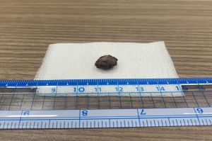 Một bệnh nhân bị sỏi trong hốc mũi hiếm gặp