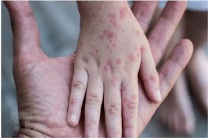 Phòng ngừa lây nhiễm bệnh đậu mùa khỉ ở động vật