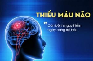 Cảnh báo dấu hiệu của thiếu máu não thoáng qua