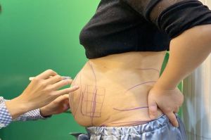 Một trường hợp tử vong sau khi đi hút mỡ bụng, cằm, đùi