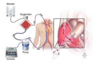Bệnh viện Nhi đồng Đồng Nai tiếp nhận kỹ thuật chạy ECMO