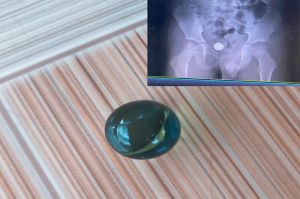 Cảnh báo trẻ nuốt dị vật