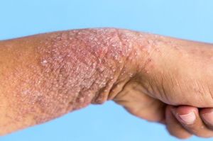 Triển khai phòng khám vảy nến tại Bệnh viện Da liễu Đồng Nai