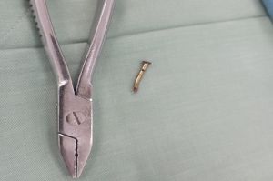 Té ngã trên giường, bé trai bị cây đinh đâm vào xương sọ