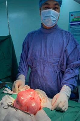 Một bệnh nhân có khối u xơ tử cung “khủng”