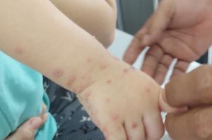 Nhiều bệnh nhi mắc tay chân miệng phải thở máy