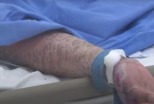 Tự ý dùng thuốc, bệnh nhân bị nhiễm độc hoại tử thượng bì rất nặng