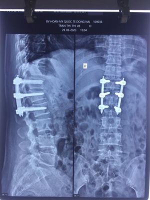 Phẫu thuật xâm lấn tối thiểu chữa gãy cột sống cho bệnh nhân bị tai nạn nghiêm trọng