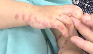 Số ca bệnh tay chân miệng và sốt xuất huyết tiếp tục tăng