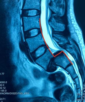 Bệnh viện Hoàn Mỹ ITO Đồng Nai thực hiện thành công ca phẫu thuật, điều trị trượt thân đốt sống độ 4