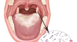 Bộ Y tế đề nghị các địa phương khẩn trương phòng bệnh bạch hầu