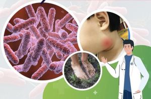 Chủ động phòng bệnh Whitmore