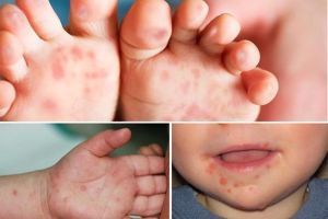 Cẩn trọng với bệnh tay chân miệng