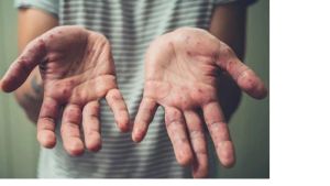 Đồng Nai ghi nhận ca bệnh đậu mùa khỉ thứ 2