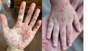 Tăng cường phòng bệnh đậu mùa khỉ trên địa bàn tỉnh