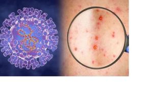 Cẩn trọng với bệnh đậu mùa khỉ