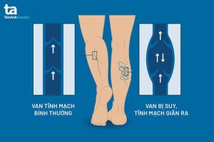 Nhận biết và điều trị bệnh suy giãn tĩnh mạch
