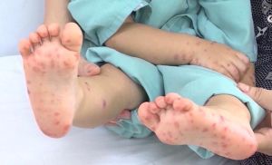 Bệnh tay chân miệng tăng 46% trong tháng 11