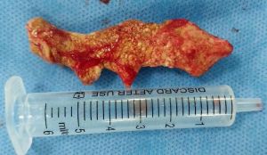 Bệnh viện Quốc tế Hoàn Mỹ Đồng Nai vừa phẫu thuật lấy sỏi thận san hô phức tạp cho nữ bệnh nhân trẻ bị dị tật hiếm gặp