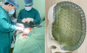 Cụ ông được tạo hình khuyết sọ 3D lưới titanium