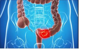 Những điều cần biết về bệnh ung thư đại tràng