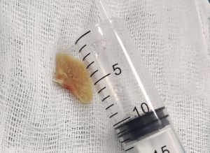 Nội soi phế quản lấy xương cá mắc trong phế quản cụ ông