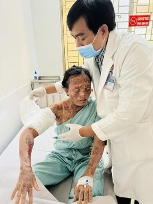 Cảnh báo bỏng cồn nguy hiểm