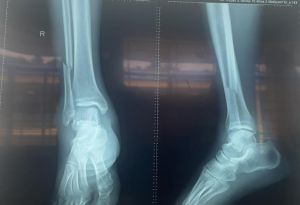 Phẫu thuật kết hợp xương cho bệnh nhân bị gãy xương do tai nạn giao thông