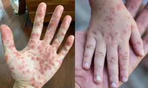 Cẩn trọng với bệnh đậu mùa khỉ