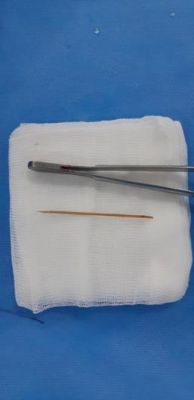 Bệnh viện Hoàn Mỹ Đồng Nai vừa phẫu thuật, lấy thành công chiếc tăm tre ra khỏi manh tràng cho người bệnh