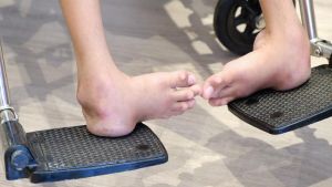 Phẫu thuật miễn phí chỉnh hình bàn chân khoèo cho 2 bệnh nhân người đồng bào Xơ Đăng