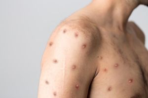 Đồng Nai ghi nhận ca bệnh đậu mùa khỉ thứ 4