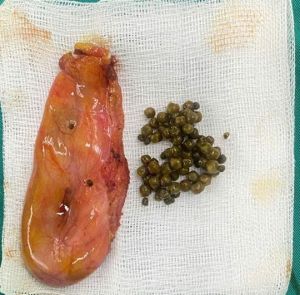 Gắp hơn 50 viên sỏi trong túi mật nữ bệnh nhân trẻ