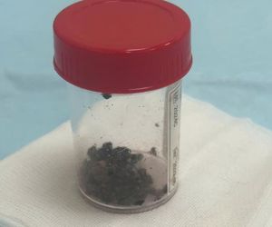 Tán sỏi thận phức tạp qua da bằng phương pháp hiện đại