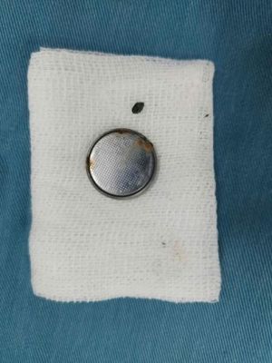 Kịp thời phẫu thuật nội soi lấy cục pin trong thực quản bệnh nhi 4 tuổi