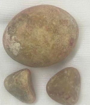 Phòng ngừa sỏi đường tiết niệu