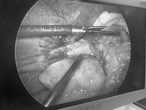 Cấp cứu kịp thời một nam bệnh nhân bị thủng túi thừa manh tràng có nguy cơ tử vong.