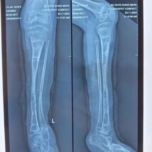 Một bé gái được phẫu thuật kéo dài chân chữa bệnh chân cao chân thấp