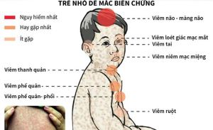 Đồng Nai ghi nhận thêm 1 ca tử vong nghi do bệnh sởi biến chứng